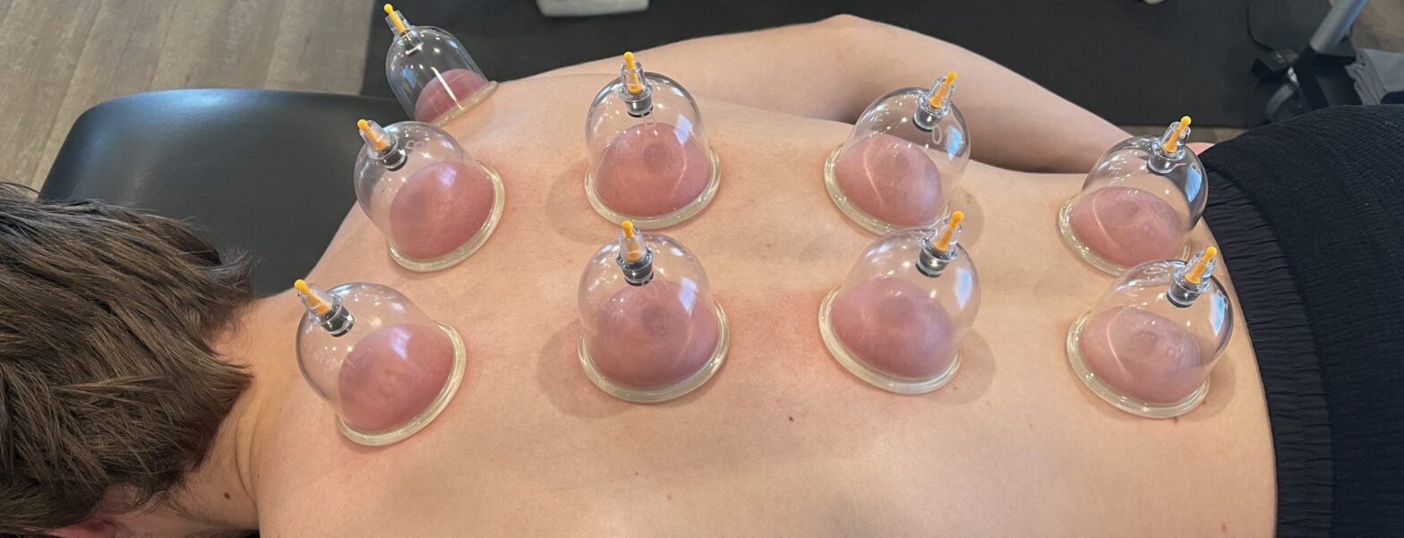 Cupping Therapy