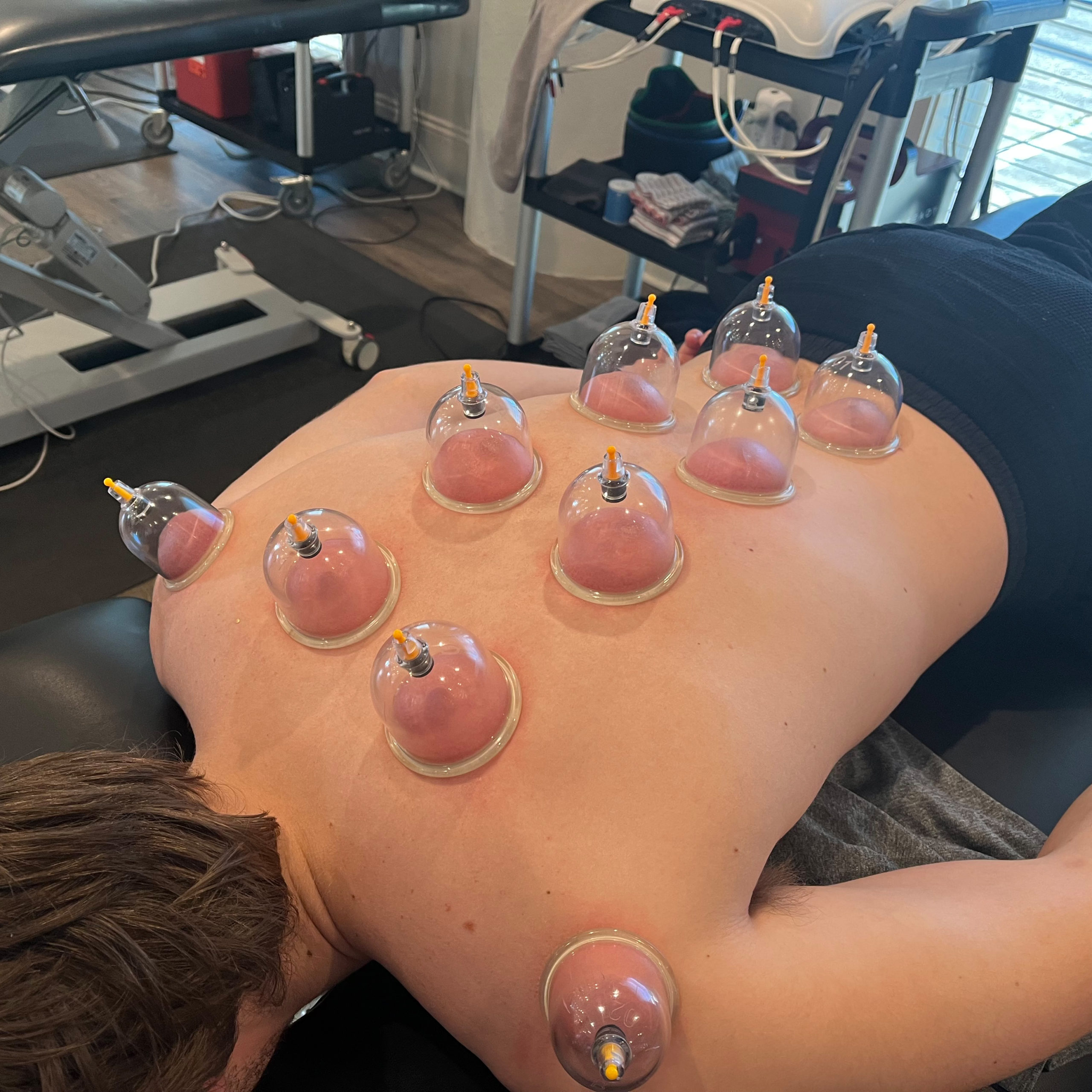 Cupping Therapy